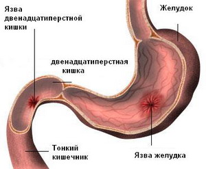 The symptoms of a peptic ulcer 12-duodenal ulcer