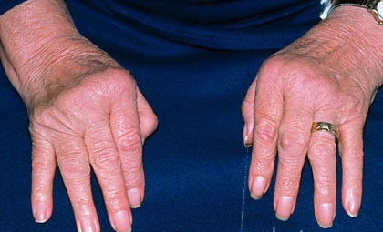  ревматоидный артрит суставов