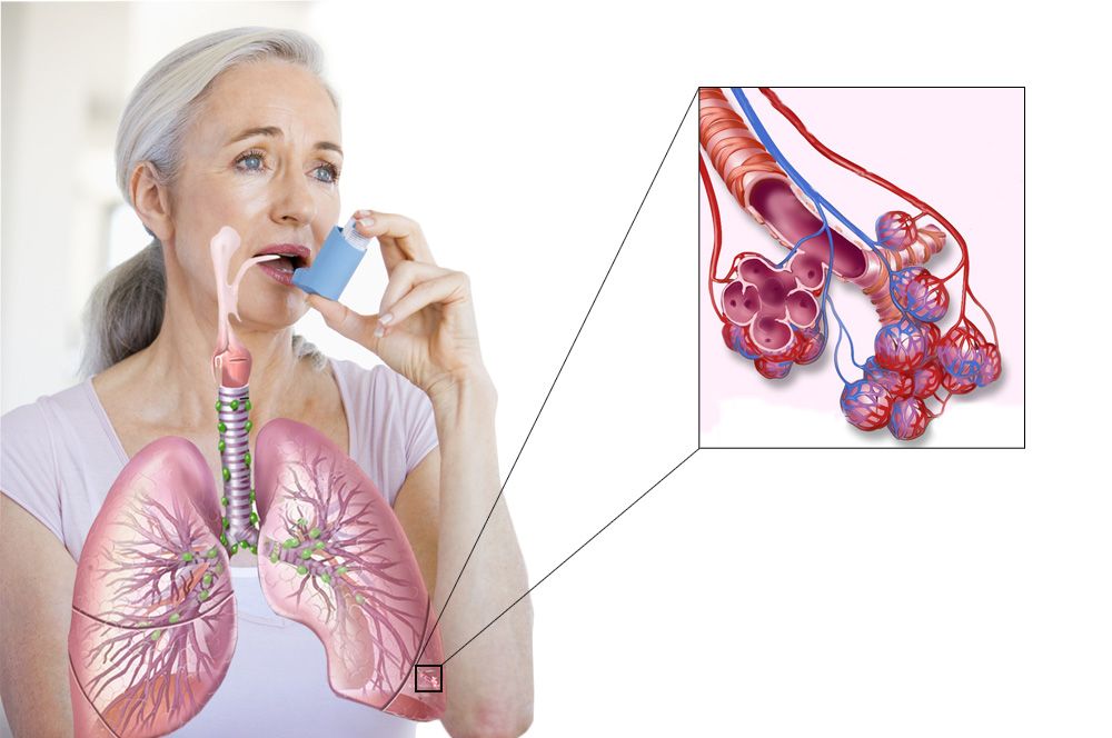 Verschlimmerung von Asthma