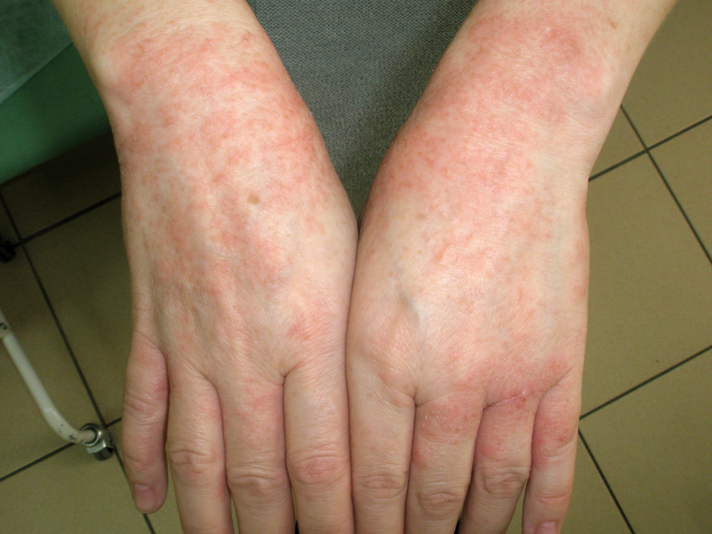 湿疹的类型和治疗