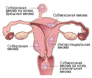 děložní fibroidy