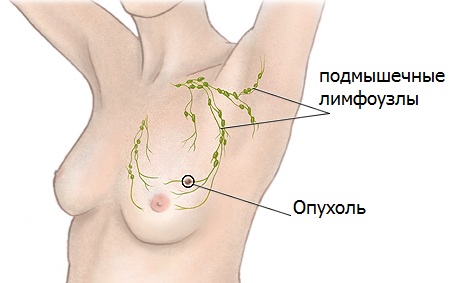 Особенности рака молочной железы 