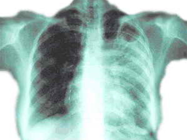 肺结核