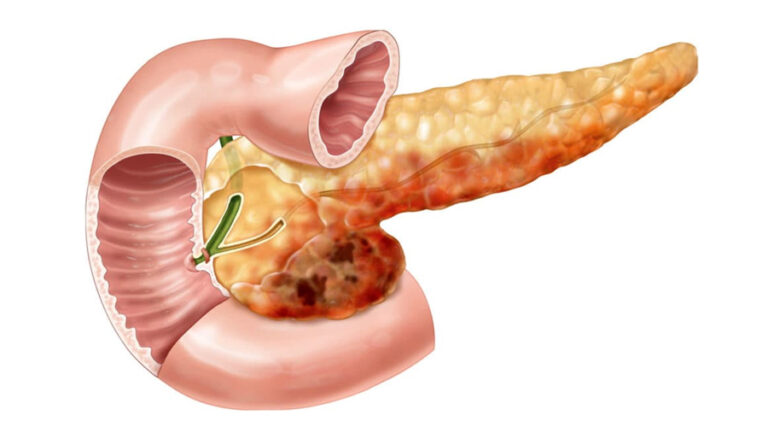 Панкреатит — симптомы и лечение